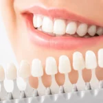 boutique teeth whitening isle of man, boutique whitening, teeth whitening isle of man, professional teeth whitening, boutique whitening reviews, home teeth whitening kit, boutique whitening how long does it last, best teeth whitening isle of man