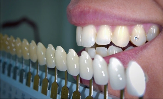 boutique teeth whitening isle of man, boutique whitening, teeth whitening isle of man, professional teeth whitening, boutique whitening reviews, home teeth whitening kit, boutique whitening how long does it last, best teeth whitening isle of man