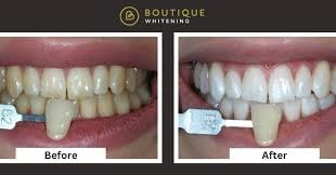 boutique teeth whitening isle of man, boutique whitening, teeth whitening isle of man, professional teeth whitening, boutique whitening reviews, home teeth whitening kit, boutique whitening how long does it last, best teeth whitening isle of man