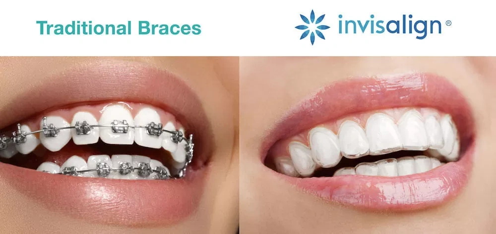 clear braces vs invisalign isle of man, Clear braces vs Invisalign Isle of Man comparison at Isle of Man Orthodontics, clear braces, invisalign, 3m clarity braces, clear aligners vs braces, invisible braces isle of man, teeth straightening isle of man, braces or invisalign, best braces for adults isle of man