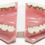 lingual braces isle of man, lingual braces, hidden braces, braces behind teeth, invisible braces isle of man, lingual appliances, lingual braces vs invisalign, incognito braces, lingual braces adults