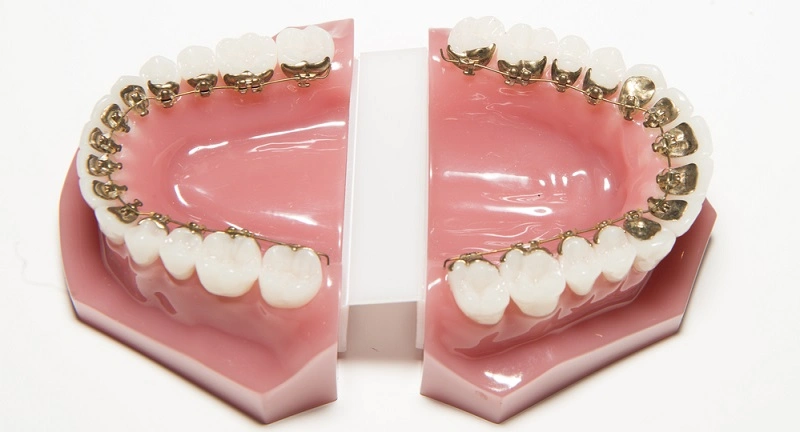 Lingual Braces Isle of Man – The Truly Invisible Way to Straighten Your Teeth