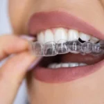 clear aligners isle of man, how do clear aligners work, aligner treatment isle of man, invisalign isle of man, clear aligner treatment, removable braces isle of man, teeth straightening isle of man, clear aligners for adults, aligner treatment cost isle of man
