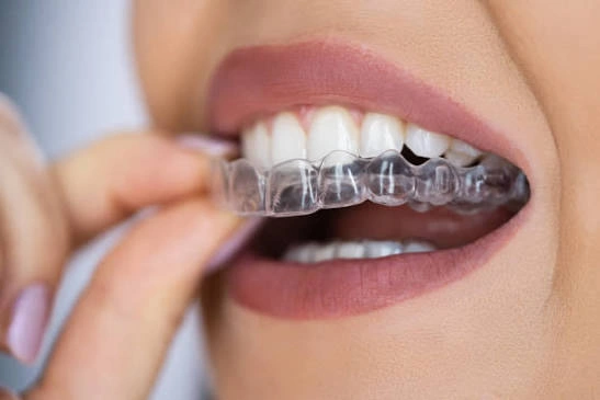 Clear Aligners Isle of Man – How They Work and Whether They Are Right for You